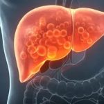 Fatty Liver Alert: AIIMS डॉक्टर बोले- तुरंत छोड़ दें ये 4 चीजें, शराब जितना पहुंचाती हैं लिवर को नुकसान
