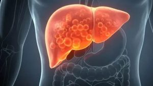 Fatty Liver Alert: AIIMS डॉक्टर बोले- तुरंत छोड़ दें ये 4 चीजें, शराब जितना पहुंचाती हैं लिवर को नुकसान