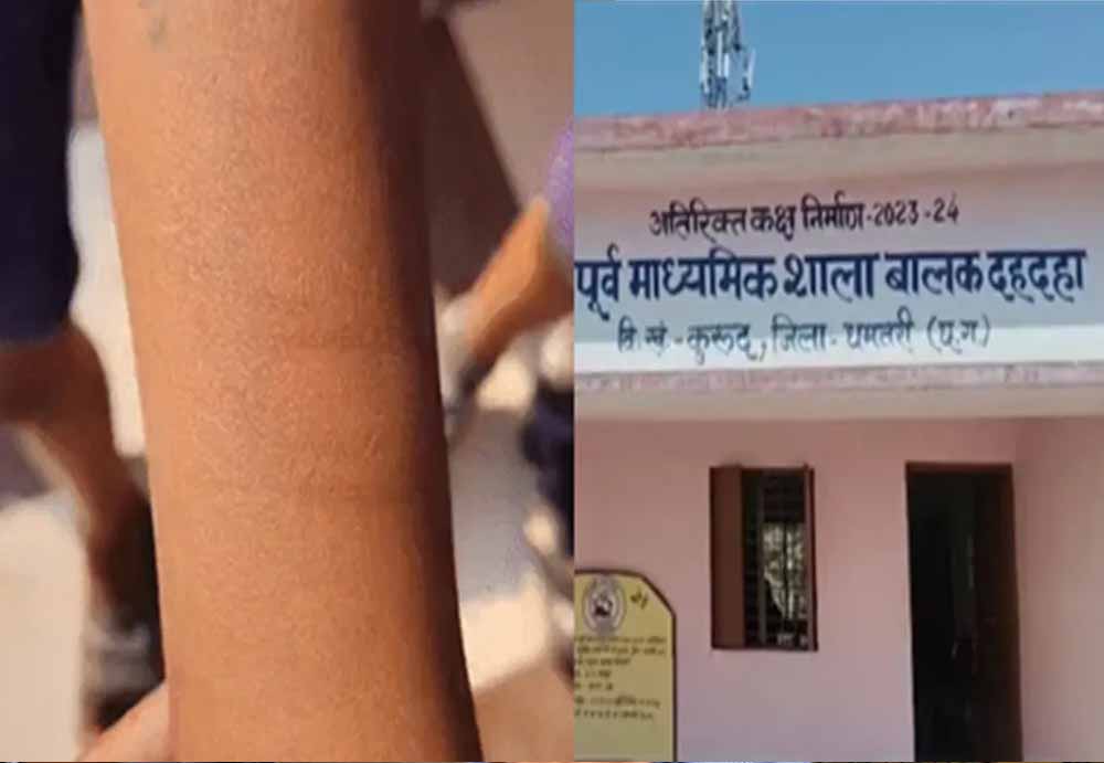 छत्तीसगढ़ के स्कूल में हड़कंप, छात्र ने 12 सहपाठियों को काटा; स्वास्थ्य विभाग मौके पर पहुंचा छत्तीसगढ़ के स्कूल में हड़कंप, छात्र ने 12 सहपाठियों को काटा; स्वास्थ्य विभाग मौके पर पहुंचा