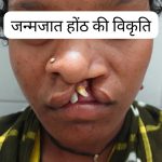 जन्मजात होंठ की विकृति का हुआ सफल उपचार, अब सामान्य जीवन जी रही हैं 22 वर्षीय युवती जन्मजात होंठ की विकृति का हुआ सफल उपचार, अब सामान्य जीवन जी रही हैं 22 वर्षीय युवती