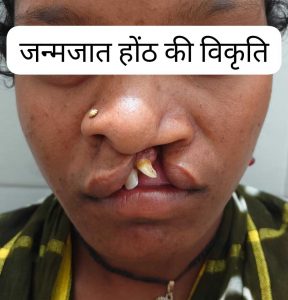 जन्मजात होंठ की विकृति का हुआ सफल उपचार, अब सामान्य जीवन जी रही हैं 22 वर्षीय युवती जन्मजात होंठ की विकृति का हुआ सफल उपचार, अब सामान्य जीवन जी रही हैं 22 वर्षीय युवती