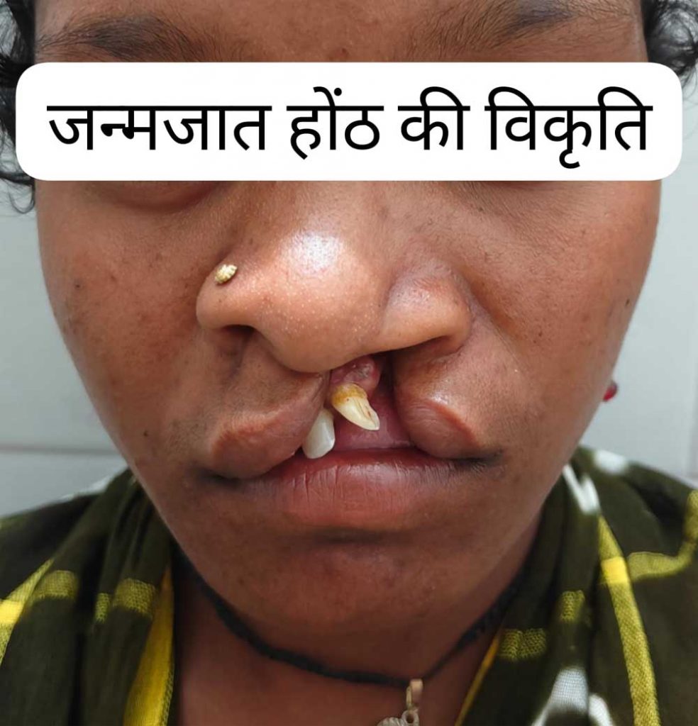 जन्मजात होंठ की विकृति का हुआ सफल उपचार, अब सामान्य जीवन जी रही हैं 22 वर्षीय युवती जन्मजात होंठ की विकृति का हुआ सफल उपचार, अब सामान्य जीवन जी रही हैं 22 वर्षीय युवती