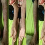 नामुमकिन हुआ मुमकिन! AIIMS रायपुर में ‘लाइलाज’ समझी जा रही बीमारी का सफल इलाज नामुमकिन हुआ मुमकिन! AIIMS रायपुर में ‘लाइलाज’ समझी जा रही बीमारी का सफल इलाज