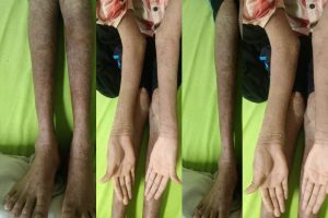 नामुमकिन हुआ मुमकिन! AIIMS रायपुर में ‘लाइलाज’ समझी जा रही बीमारी का सफल इलाज नामुमकिन हुआ मुमकिन! AIIMS रायपुर में ‘लाइलाज’ समझी जा रही बीमारी का सफल इलाज