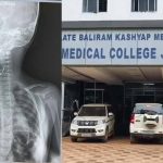 मेडिकल कॉलेज के डॉक्टरों की बड़ी सफलता, बच्ची के गले से दूरबीन पद्धति से निकाला सेफ्टी पिन