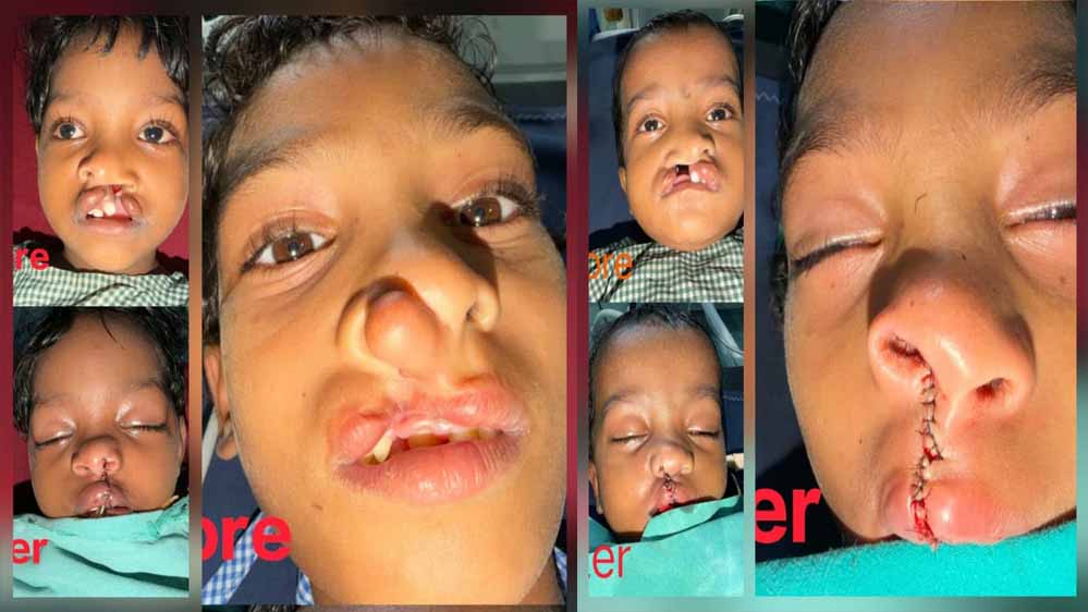 चिरायु योजना से जन्मजात समस्या से मिली राहत, तीन बच्चों के चेहरों पर लौटी मुस्कान चिरायु योजना से जन्मजात समस्या से मिली राहत, तीन बच्चों के चेहरों पर लौटी मुस्कान