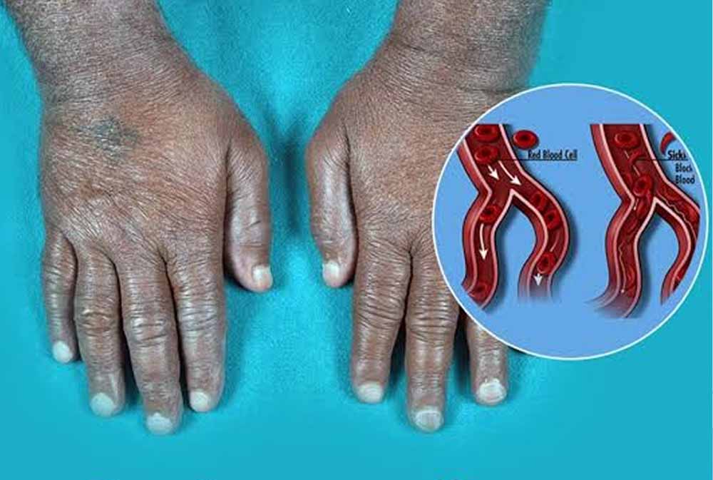 सिकल सेल को लेकर बस्तर में बड़ा अभियान, 6 लाख से अधिक लोगों की जांच