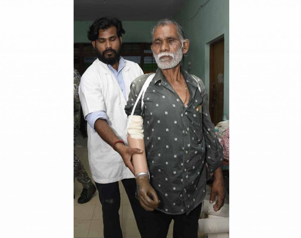 ट्रेन हादसे के दर्द पर ‘सेवा संकल्प’ का मरहम, धमतरी के तेजराम को दो घंटे में मिला कृत्रिम हाथ, लौटी जिंदगी की रंगत
